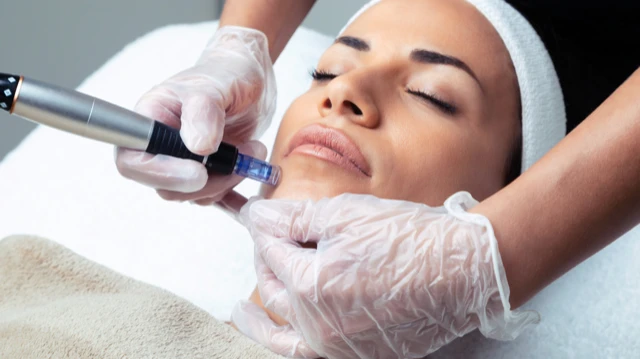 Woman getting microneedling treatment